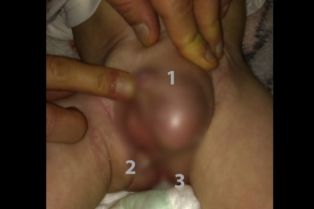 В Ираке родился ребенок с тремя пенисами
