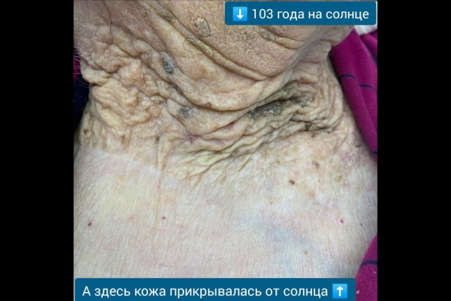 Как солнце уродует кожу: на примере 103 летней женщины