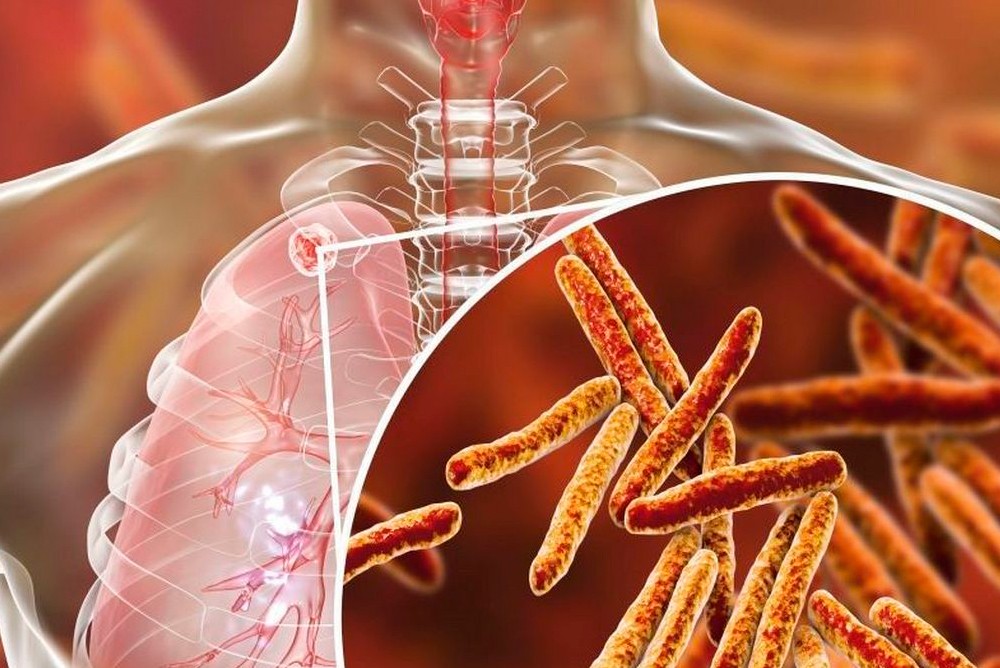 Скрытый убийца: Туберкулез может передаваться просто при дыхании