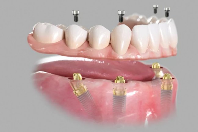 All-on-4 – инновационный подход к имплантации зубов