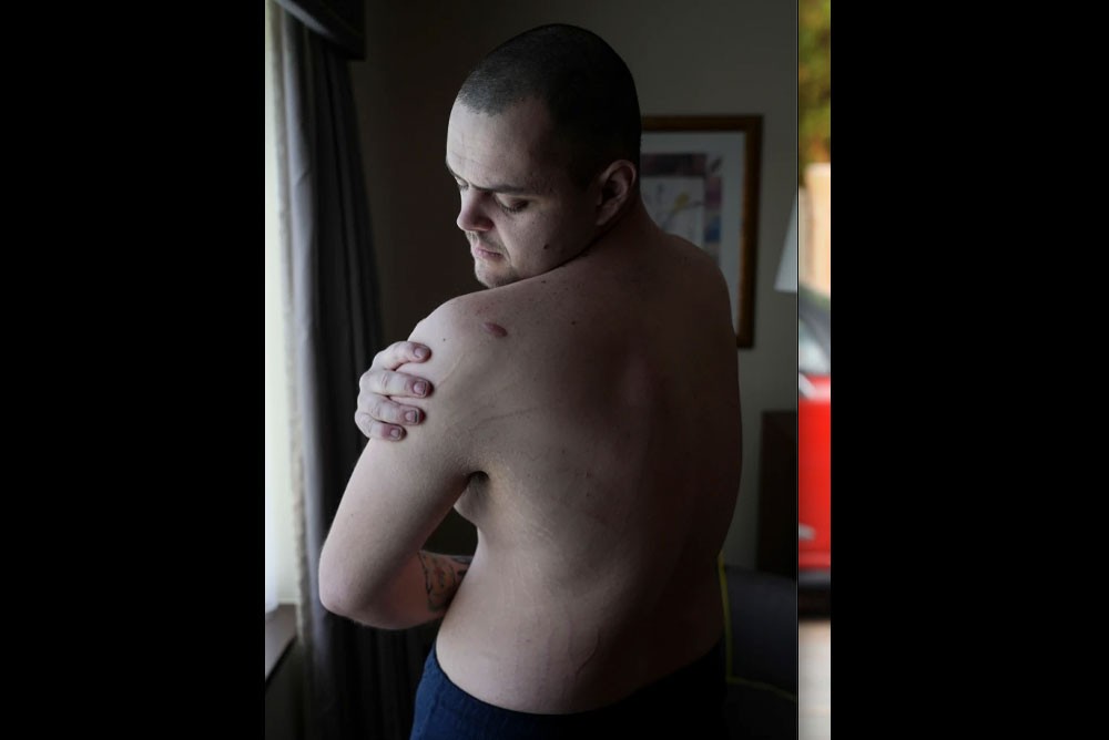Храбрый 28-летний Эйден Аслин показал родинку и растяжки от ожирения на своей спине