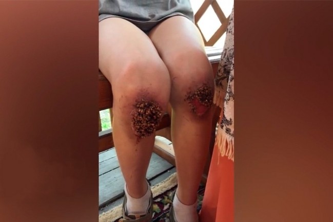 Вросшая в колени ребенка гречневая крупа: после пыток - стояние коленями на гречке