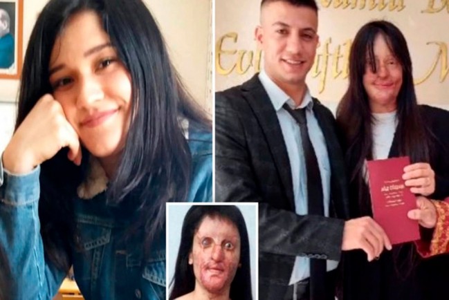 В Турции девушка с обезображенным от кислоты лицом, согласилась выйти замуж за обидчика