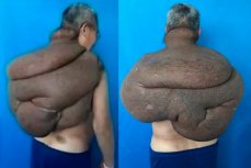 Мужчина с огромной 15-килограммовой опухолью