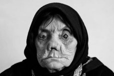 Женщина болеющая лепрой (проказой)
