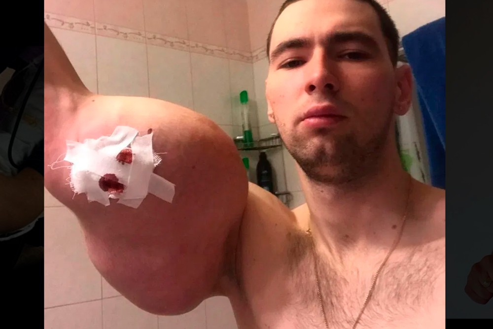 23-летнего Кирилла Терешина предупредили, что он может умереть, если не удалить имплантаты