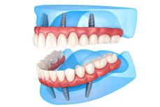 Полное восстановление зубного ряда на четырех имплантах
